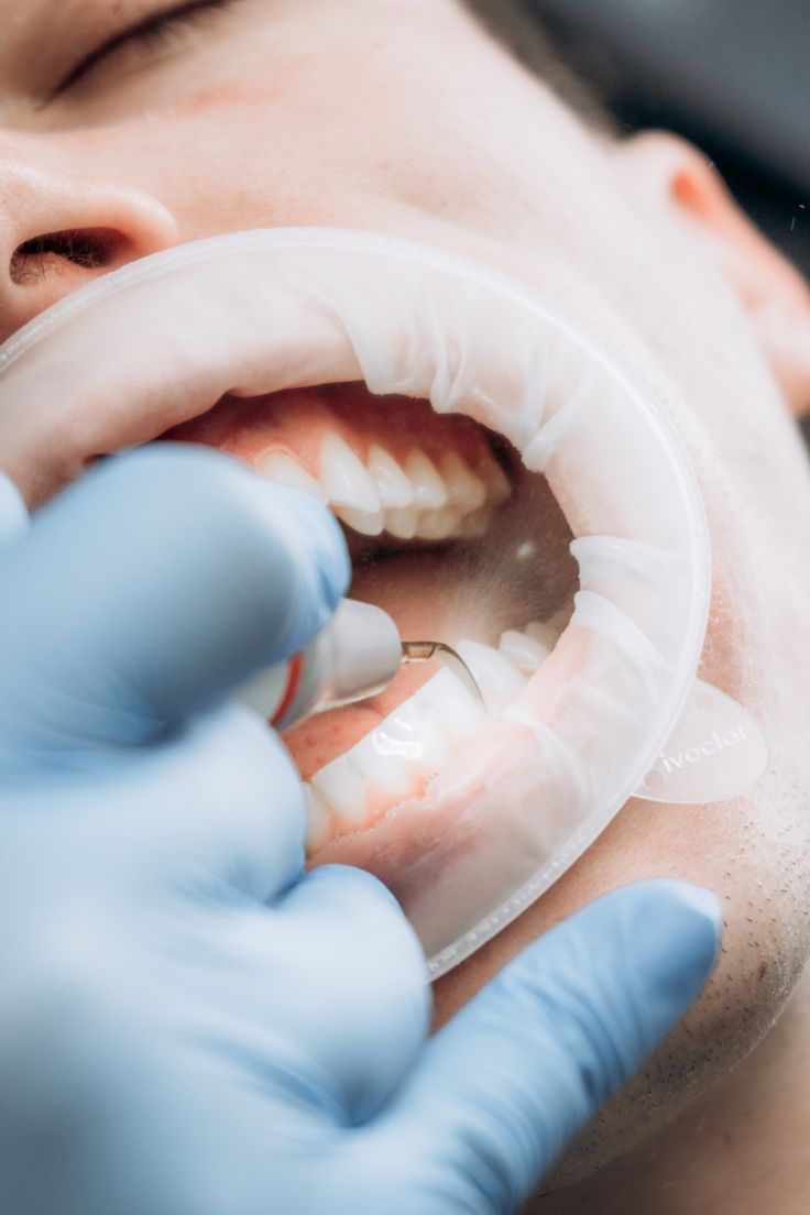 Teeth Whitening